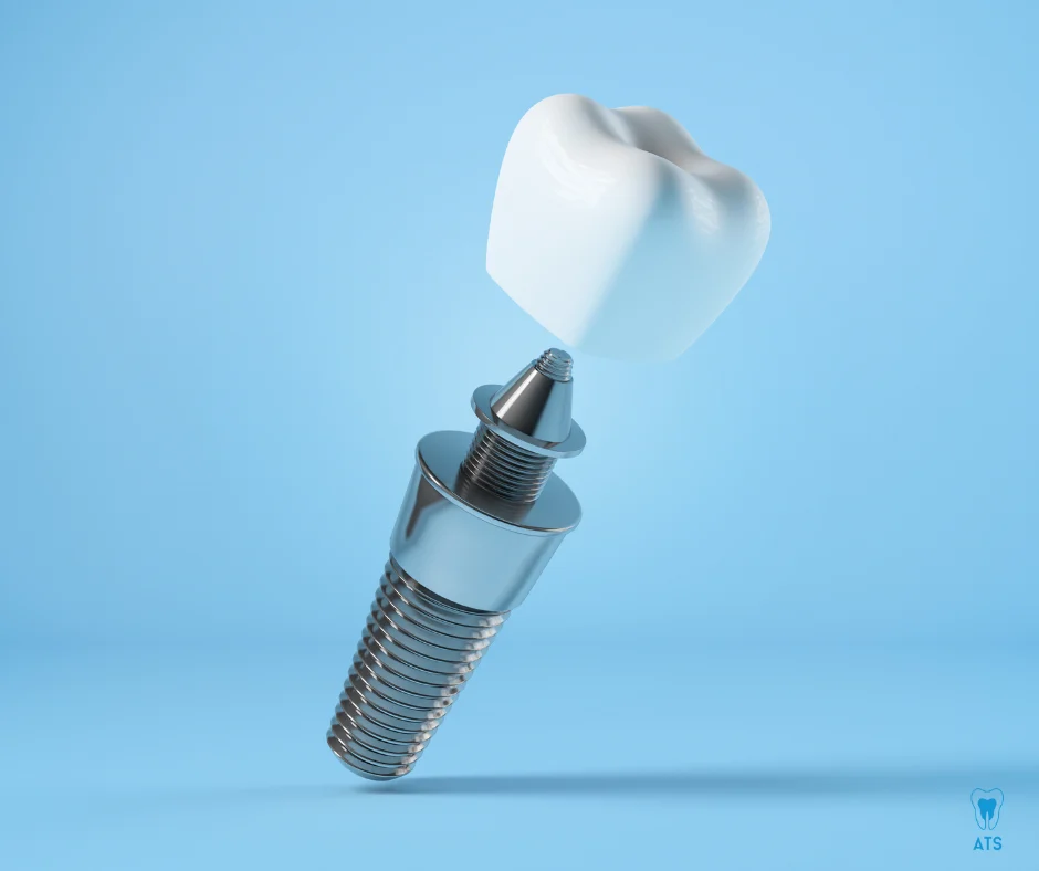 dental implants treatment in Thoraipakkam