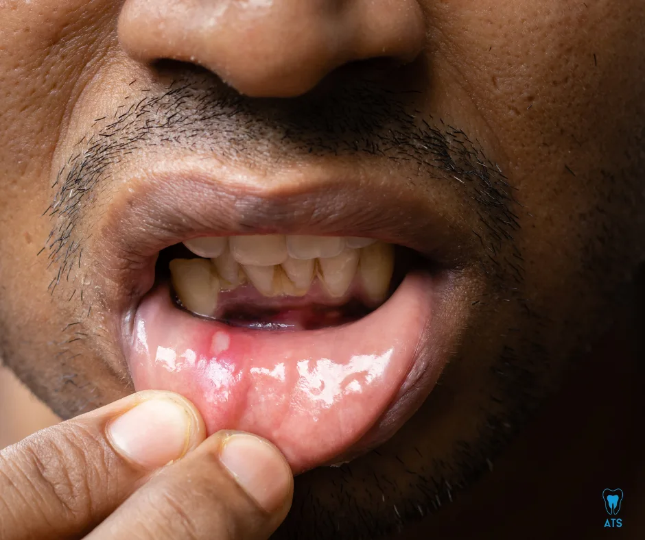 Mouth ulcer treatment in Thoraipakkam