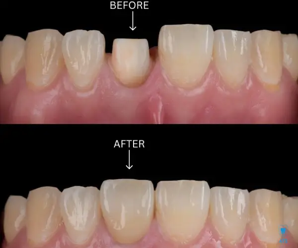 Dental Crowns